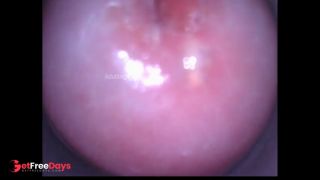 Cervix behind the scenes heartbeat pulse raw footage Nabothian cyst