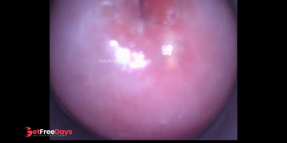 Cervix behind the scenes heartbeat pulse raw footage Nabothian cyst